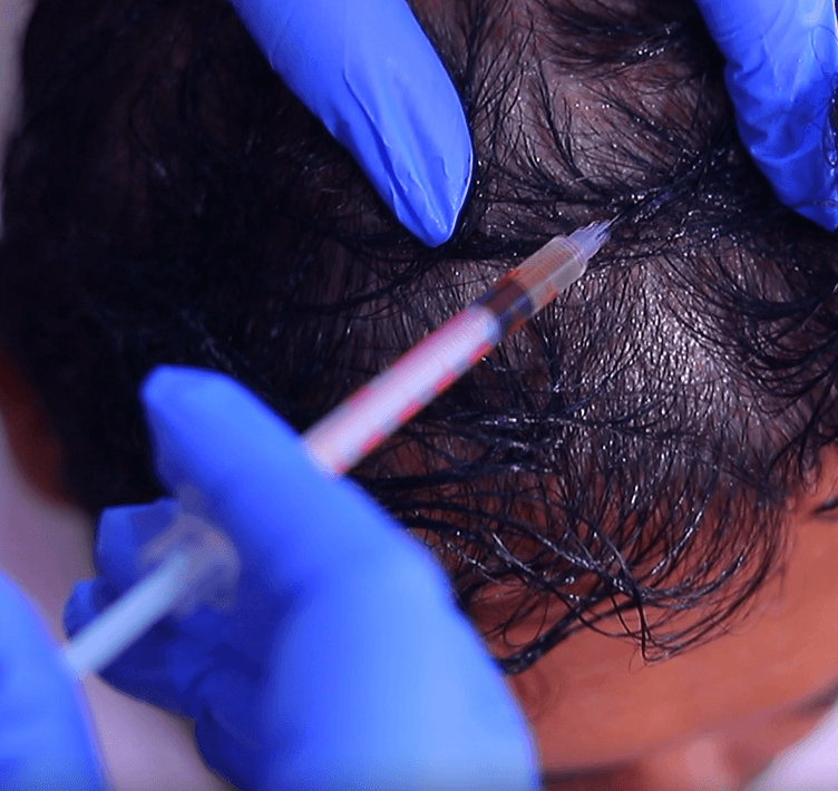 Scalp Micro-Injection Detail